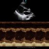 thumb: Ultraschall Herz mit dem Apogee 2300
