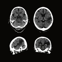 thumb: Hirnscan mit dem Aquilion Lightning SP