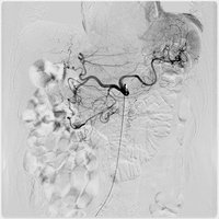 thumb: Angiographie mit dem Ultimax-i