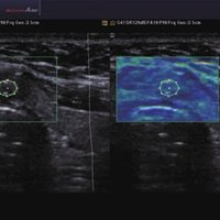 thumb: Schilddrüße - Ithmus Adenoma ElastoScan