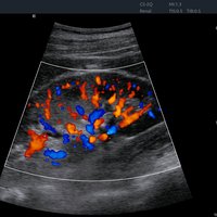 thumb: Farbdoppler ohne TAI