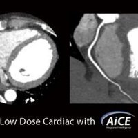 thumb: Herzscan nach einer Rotation mit dem Aquilion One PRISM Edition