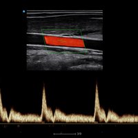 thumb: Blutfluss mit dem Apogee 6200