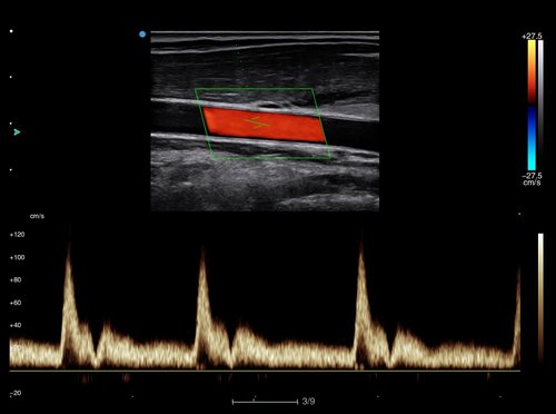 Blutfluss mit dem Apogee 6200