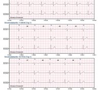 thumb: Cardiomatics Report Beispiel 3