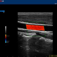 thumb: Karotisarterie