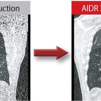 thumb: AIDR 3D Algorithmus des Aquilion LB