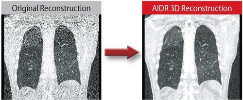 AIDR 3D Algorithmus des Aquilion LB