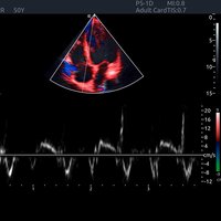 thumb: Tissue Velocity Imaging