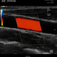 thumb: Karotide mit CF