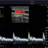 thumb: Ultraschalldiagnostik mit dem Acclarix LX9