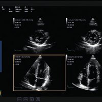 thumb: Herz-Stress-Echo - mit flexiblen und anpassbaren Protokollen für die Aufnahme und Überprüfung von Bildern