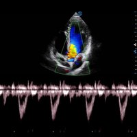 thumb: Ultraschalluntersuchung des Herzens mit dem Apogee 6500