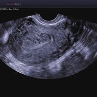 thumb: Uterus Adenomyosis