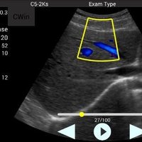 thumb: Abdominalscan mit dem Farbdoppler des Youkey QSONO D8