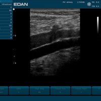 thumb: Vene, Arterie