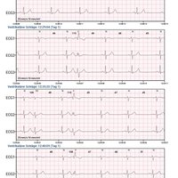 thumb: Cardiomatics Report Beispiel 4