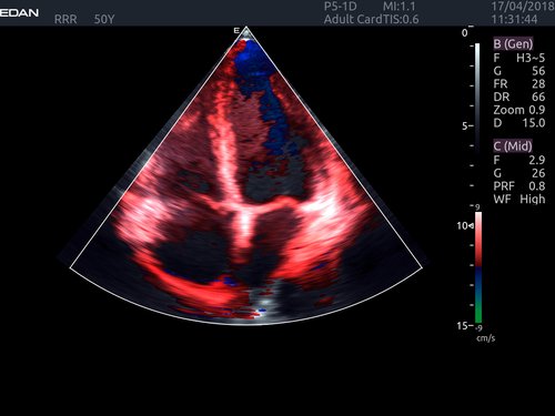 Tissue Doppler Imaging