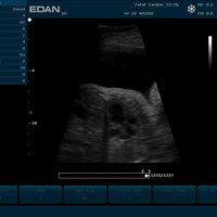 thumb: C5-2b-Sonde OB 2/3 - 29 Wochen fetaler Herz