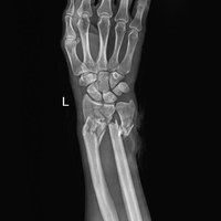 thumb: Fraktur von Radius und Ulna aufgenommen mit dem Defender 