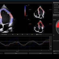 thumb: Herzscan mit dem Apogee 6500