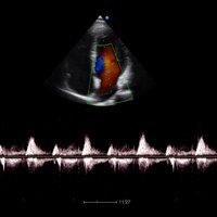 thumb: Herzscan mit dem Apogee 6200