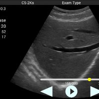 thumb: Abdominalscan mit dem Youkey QSONO D8