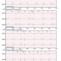 thumb: Cardiomatics Report Beispiel 5