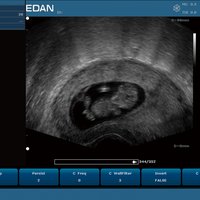 thumb: Transvaginalscan, Fetus Mask