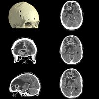thumb: Scan eines Hirnabszesses mit dem Aquilion One PRISM Edition
