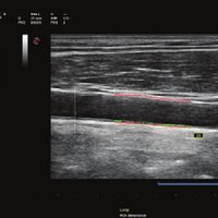 thumb: QIMT - Automatisierte Echtzeiterkennung der Intima-Media-Dicke