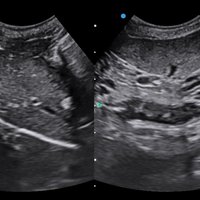 thumb: Ultraschalluntersuchung mit dem Apogee 2300V