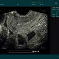 thumb: Uterus, sagittal