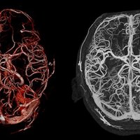 thumb: Bildgebung mit dem Aquilion Precision