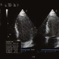 thumb: AutoEF - Automatische Messung der Ejektionsfraktion