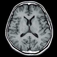 thumb: Easy Brain Protocol T1 62 Sek.