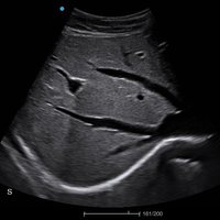 thumb: Aufnahme der Leber mit dem Apogee 1000 Lite