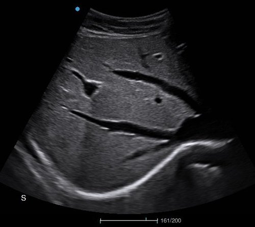 Aufnahme der Leber mit dem Apogee 1000 Lite