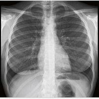 thumb: Thoraxaufnahme mit Xantara