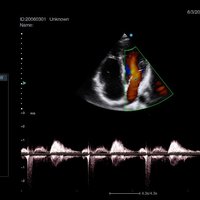 thumb: Herzscan mit dem Apogee 5300