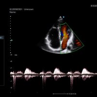 thumb: Herzscan mit dem Apogee 5300