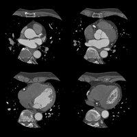 thumb: Bildgebung mit dem Aquilion Precision