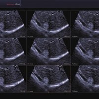 thumb: Leber Hemangioma mit 3D MSV