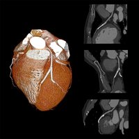 thumb: Bildgebung mit dem Aquilion Precision