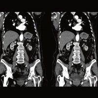 thumb: Abdominalscan mit dem Aquilion Lightning SP