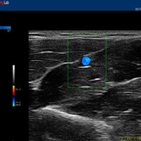 thumb: Ellenarterie