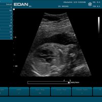 thumb: 25-Woche, fötales Herz