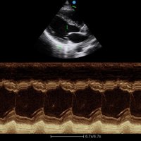 thumb: Ultraschall Herz mit dem Apogee 2300