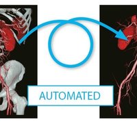 thumb: Anwendung der Knochensubstraktion mit dem Aquilion Lightning