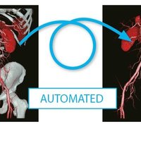 thumb: Anwendung der Knochensubstraktion mit dem Aquilion Lightning